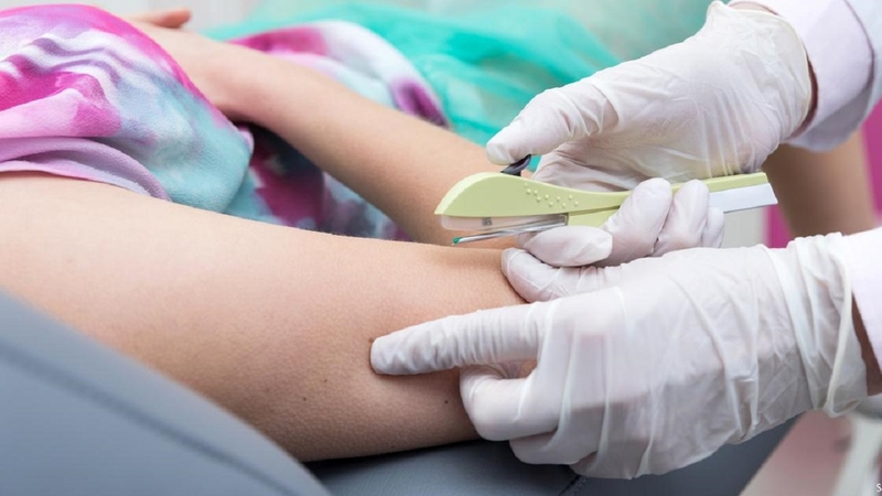 Que tránh thai là một dạng ống nhỏ có chứa thuốc tránh thai nằm ở bên trong