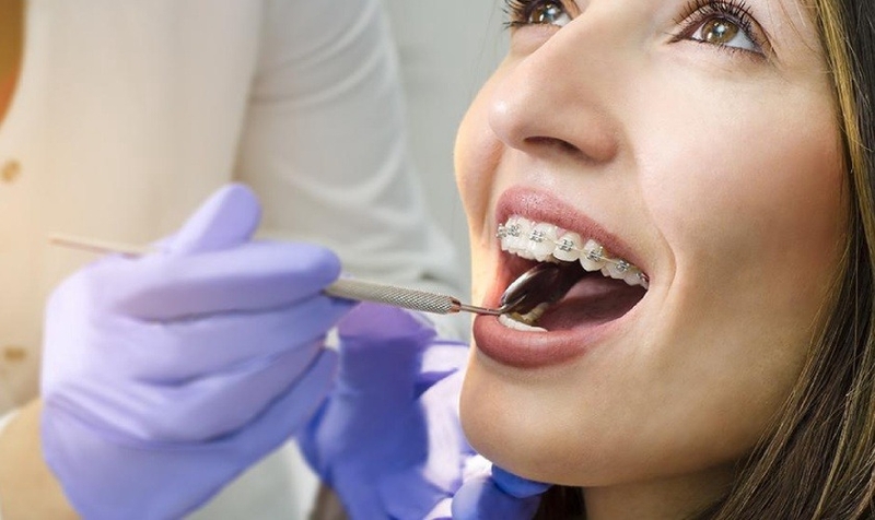 quy-trinh-cac-buoc-nieng-rang-dien-ra-nhu-the-nao 1.jpg