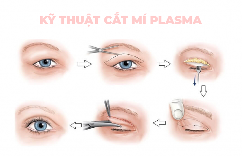 Những điều bạn cần biết trước khi phẫu thuật cắt mí Plasma 2