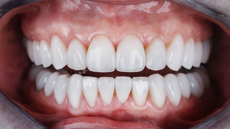 Dán răng sứ ngày càng được nhiều người lựa chọn để cải thiện thẩm mỹ răng