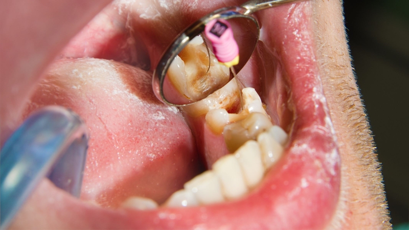 Sau khi ống tủy được làm sạch và hết viêm, bác sĩ sẽ trám bít kín ống tủy rồi phục hồi thân răng