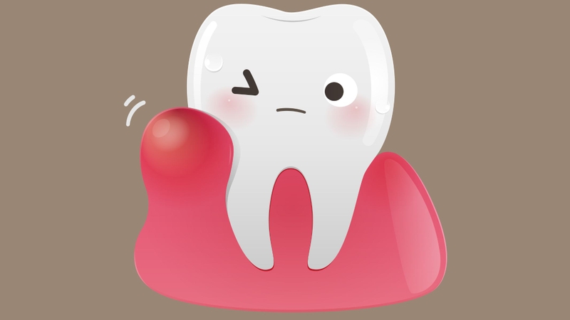 Sưng nướu, viêm nha chu có thể xảy ra do tổn thương mô nướu khi lấy tủy hoặc chăm sóc răng miệng chưa đúng sau điều trị