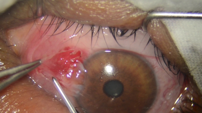 Quy trình mổ mộng thịt đầy đủ cho bệnh nhân tham khảo 2