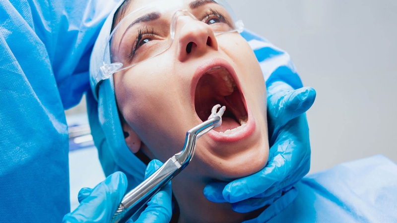 Quy trình nhổ răng khôn được tiến hành như thế nào? Cần lưu ý điều gì? 2