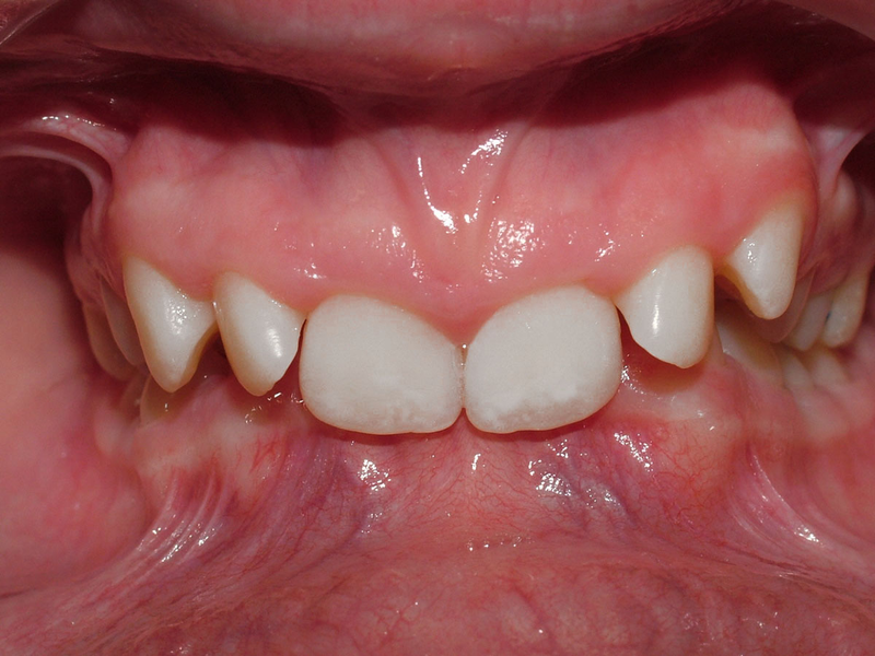 Quy trình niềng răng khớp cắn sâu gồm mấy bước?1