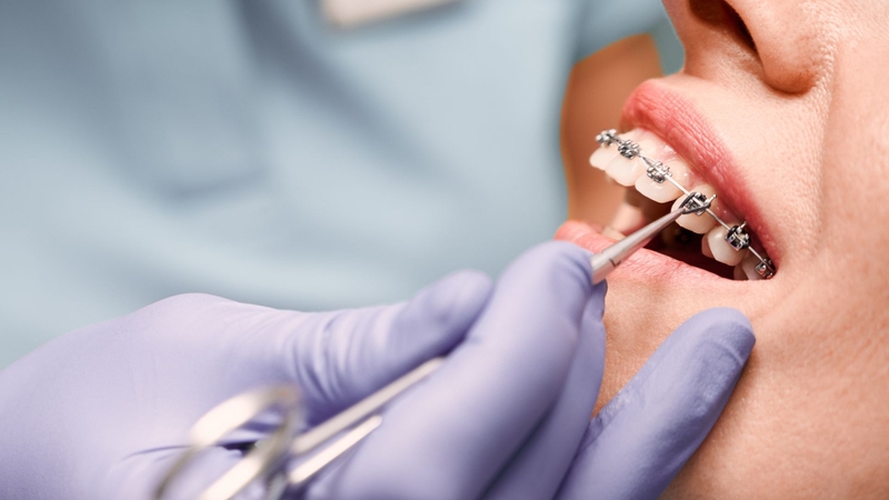 Quy trình niềng răng mắc cài kim loại chuẩn y khoa 2