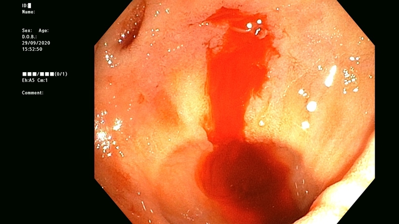 quy-trinh-noi-soi-can-thiep-cam-mau-duoc-thuc-hien-nhu-the-nao 1.jpg