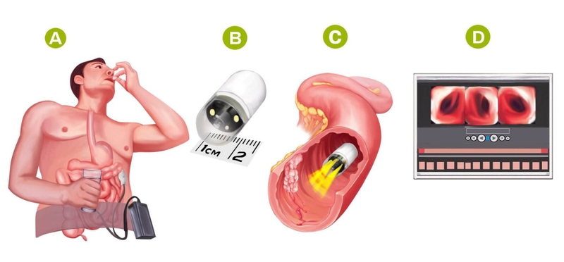 Quy trình nội soi dạ dày diễn ra như thế nào? 5