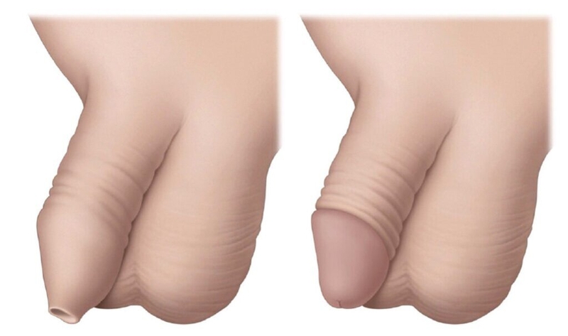 Quy trình phẫu thuật hẹp bao quy đầu diễn ra như thế nào? Một số lưu ý cần biết 1