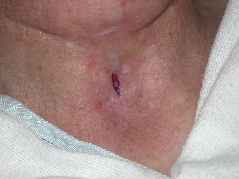 Quy trình phẫu thuật rò khe mang như thế nào? Tai biến và cách xử lý sau phẫu thuật 1