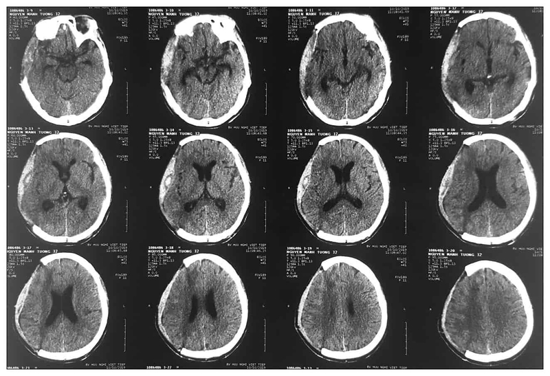 quy-trinh-phau-thuat-tu-mu-duoi-mang-cung-duoc-thuc-hien-nhu-the-nao 1.jpg