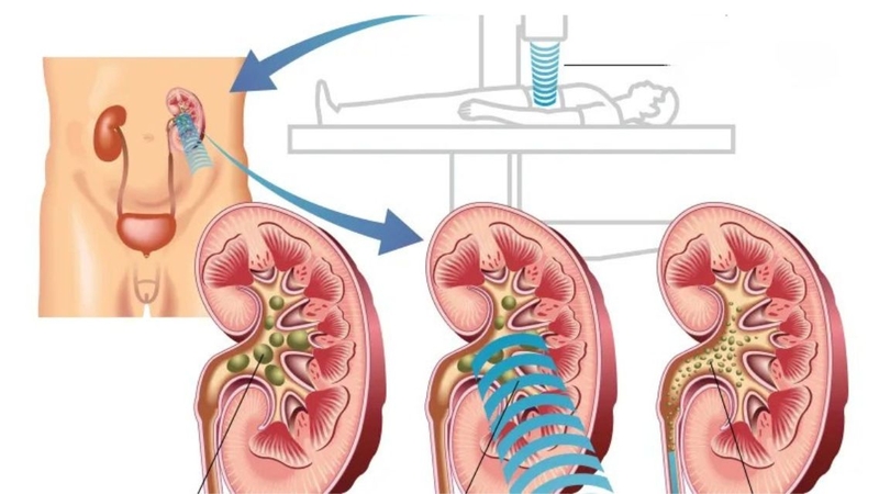 Tìm hiểu về&nbsp;quy trình tán sỏi thận&nbsp;là việc cần thiết
