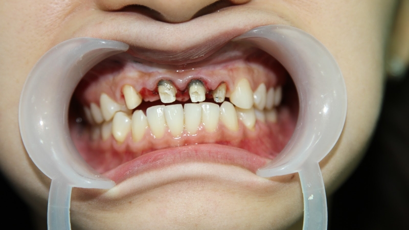 Quy trình tháo mão răng an toàn, không đau đớn 2