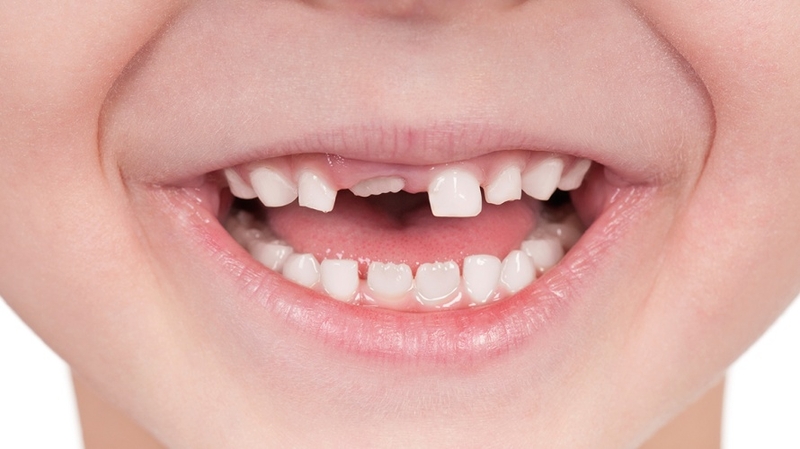 Quy trình thay răng của trẻ: Những điều bố mẹ cần biết 3