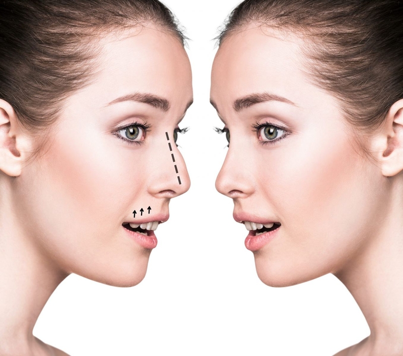 Quy trình thực hiện nâng mũi lightly là gì?1