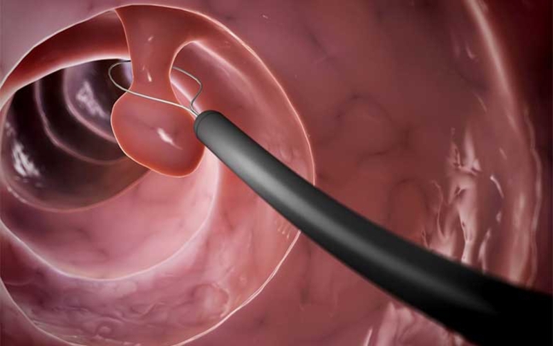 Quy trình thực hiện xoắn polyp âm đạo và những điều cần lưu ý 1