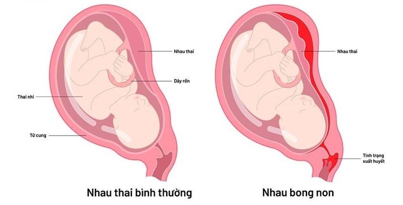 Ra máu khi mang thai tháng thứ 4: Mẹ bầu cần xử lý ra sao? 1