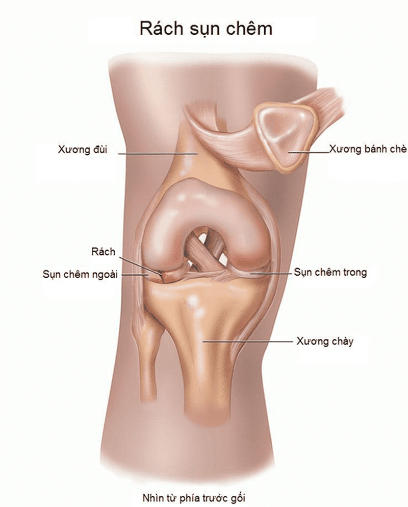 Rách sụn chêm bao lâu thì khỏi? Cần chú ý điều gì khi thực hiện các bài tập phục hồi chức năng? 1