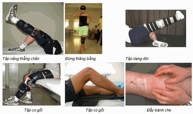 Rách sụn chêm bao lâu thì khỏi? Cần chú ý điều gì khi thực hiện các bài tập phục hồi chức năng? 4