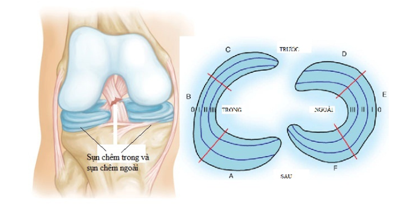 Rách sụn chêm: Dấu hiệu, nguyên nhân và hướng điều trị 1