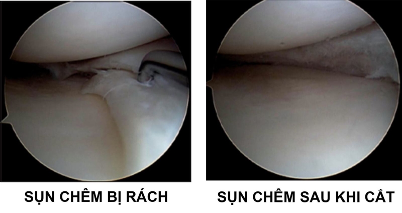 Rách sụn chêm: Dấu hiệu, nguyên nhân và hướng điều trị 4