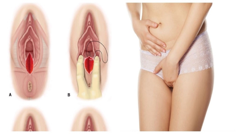 Để vết thương hồi phục tốt thì cần được chăm sóc, vệ sinh đúng cách để tránh tình trạng nhiễm trùng