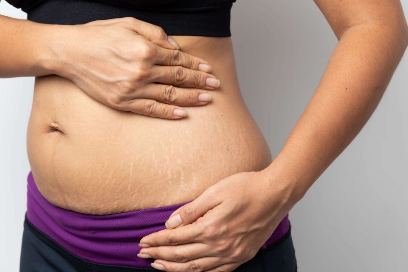 rạn da bụng sau khi sinh 2