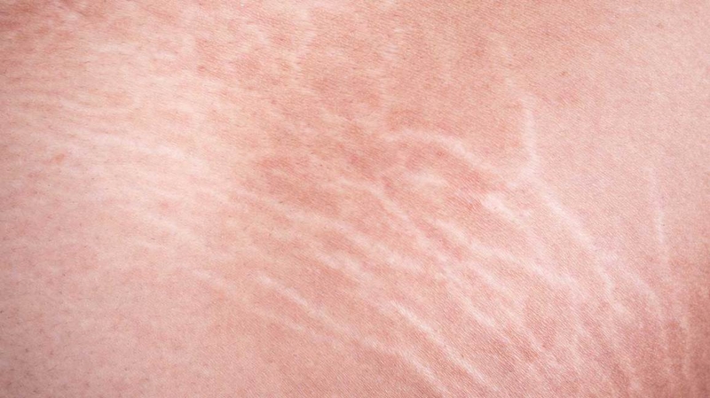 rạn da chân màu trắng