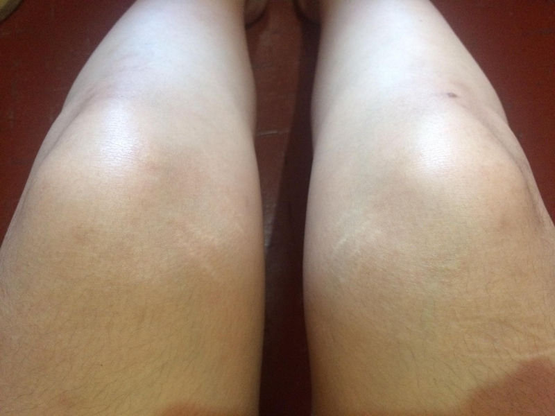 rạn da chân màu trắng 2