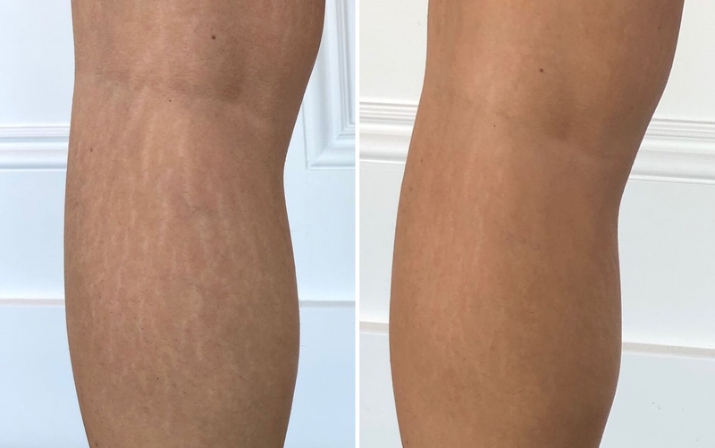 rạn da chân màu trắng 3