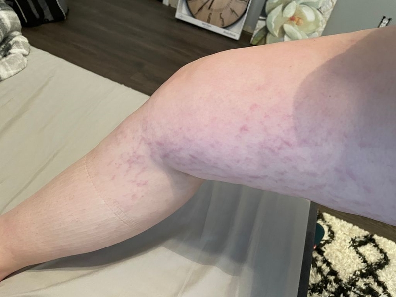 rạn da chân ở bà bầu 1