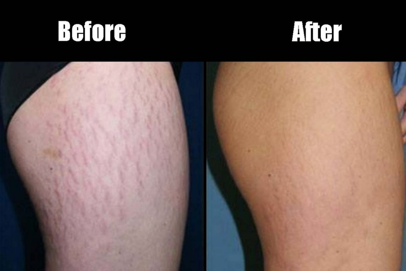 rạn da chân ở nam 3