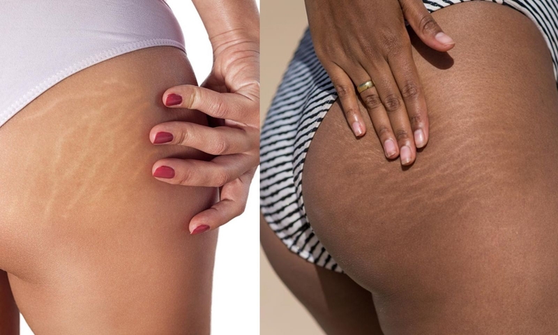 rạn da mông khi mang thai 1