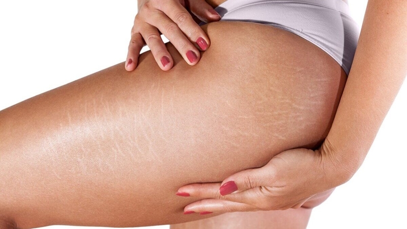 Rạn da mông là gì? Bí quyết trị rạn da mông cực hay từ A-Z 2