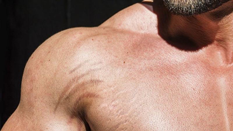 rạn da ở nam giới có chữa khỏi được không