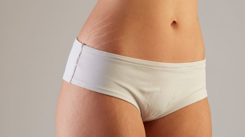 Rạn da tuổi dậy thì có hết không? 1