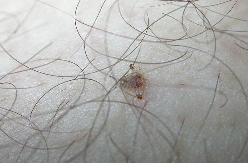 Rận mu có sống trên tóc không 1