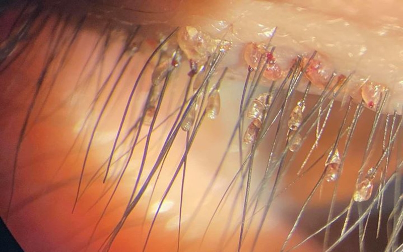 Rận mu ở trẻ em: Nguyên nhân và cách phòng ngừa 1