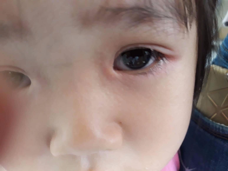 Rận mu ở trẻ em: Nguyên nhân và cách phòng ngừa 2