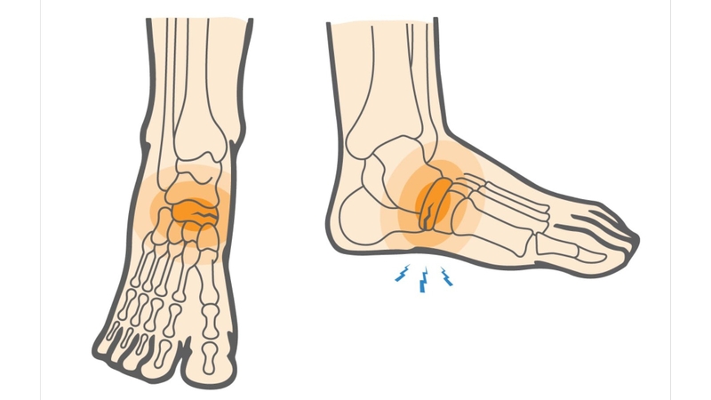 Rạn xương bàn chân có nguy hiểm không? -2