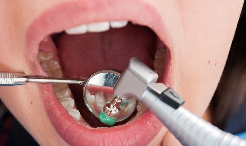 cao-voi-rang-co-lam-trang-rang-khong