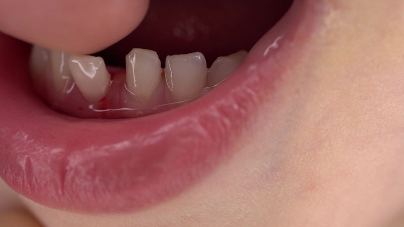 Tiêu xương nghiêm trọng làm giảm khả năng nâng đỡ chân răng