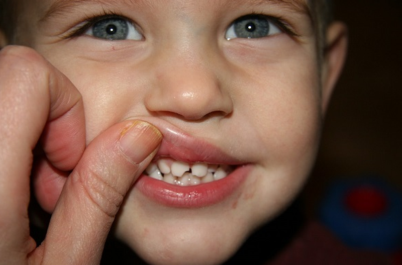 Răng bị mẻ có mọc lại được không trong trường hợp bị mất răng? 2