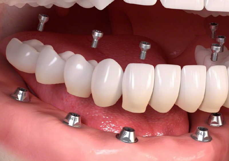 Răng bị mẻ có mọc lại được không trong trường hợp bị mất răng? 3