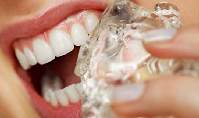 Răng bị mẻ có trám được không và quy trình trám răng bị mẻ thế nào? 2