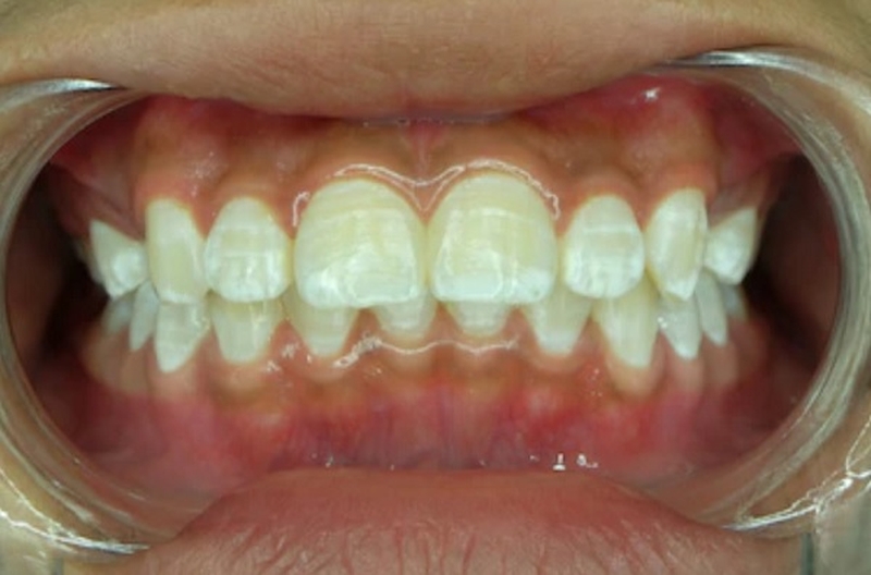 Răng bị nhiễm fluor chủ yếu bắt nguồn từ thói quen sinh hoạt hàng ngày