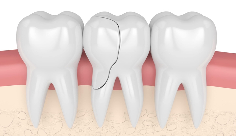 Răng bị nứt ngang là tình trạng gì? Răng bị nứt ngang phải làm sao? 1