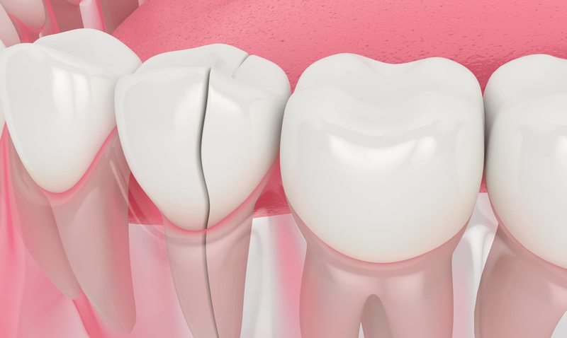 Răng bị nứt ngang là tình trạng gì? Răng bị nứt ngang phải làm sao? 3