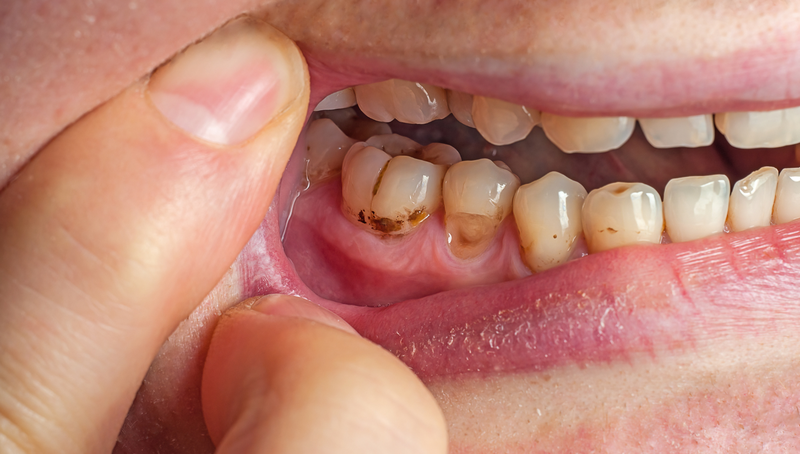 Răng bị sâu ăn mòn hết: Nguyên nhân, hậu quả và cách khắc phục hiệu quả 1