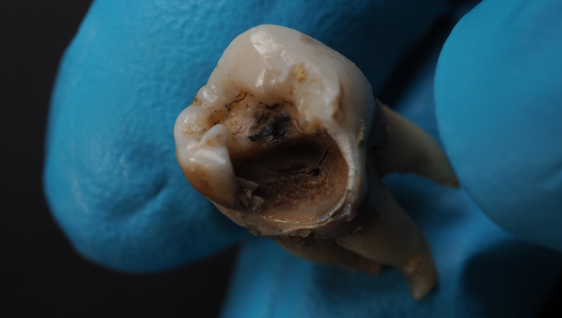 Răng bị sâu ăn mòn hết: Nguyên nhân, hậu quả và cách khắc phục hiệu quả 4